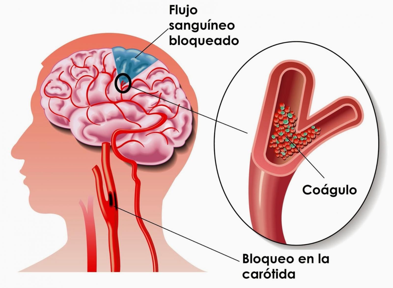 En las venas cerebrales Salud ABC Color